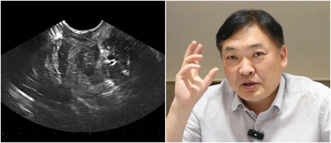 bk超声什么品牌BK特约 ｜ 专访浙江省中医院楼林：如何应用术中超声  让脑出血等手术“可视化”-上海聚慕医疗器械有限公司
