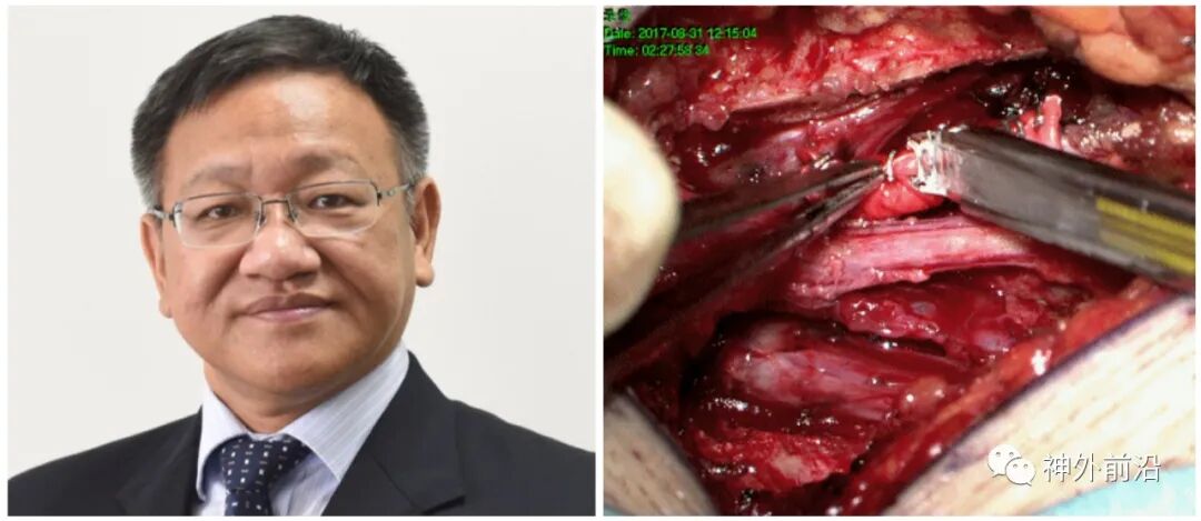 徕卡医疗是什么旗下神刀博览｜ 北医三院刘彬：3D打印硬膜神经根袖加固骶管成形术治疗神经根型骶管囊肿一例-上海聚慕医疗器械有限公司