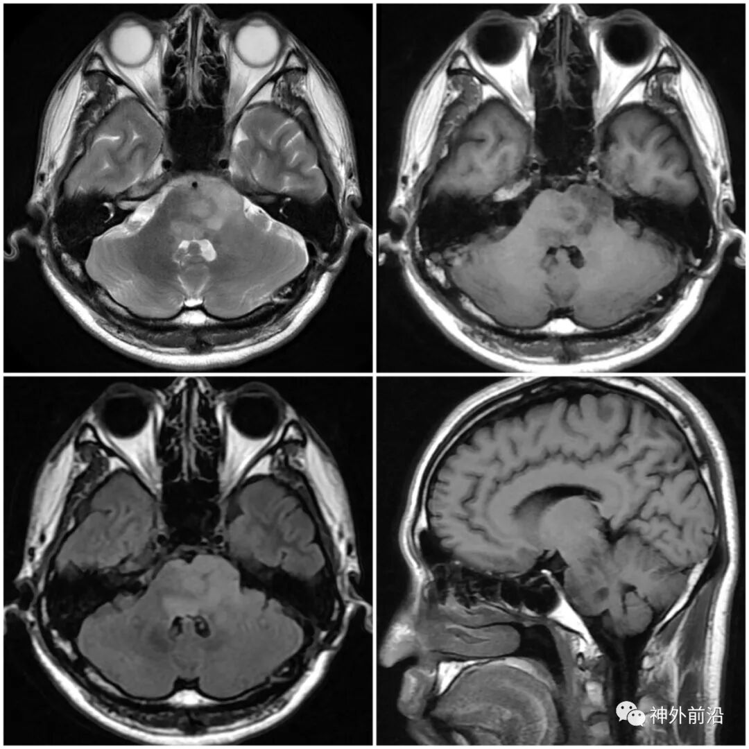 弥漫性脑干胶质瘤诊疗案例及基于h3k27突变的临床出路_医学界-助力