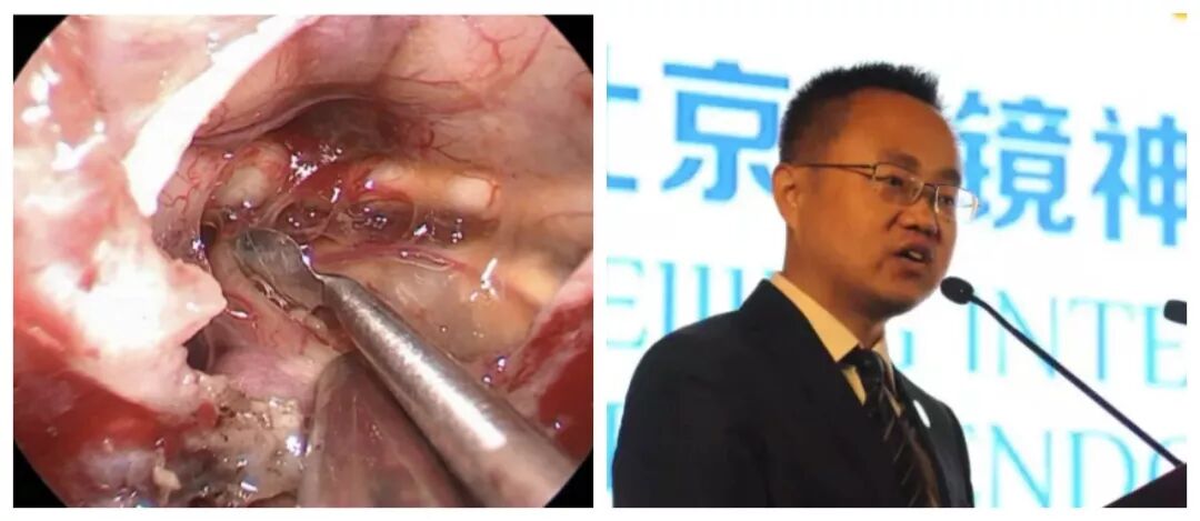 什么是显微镜手术天坛神经内镜 ｜专访桂松柏： 颅咽管瘤依是神外手术难点和挑战  内镜和显微镜技术应同时掌握_https://www.jmylbn.com_新闻资讯_第1张