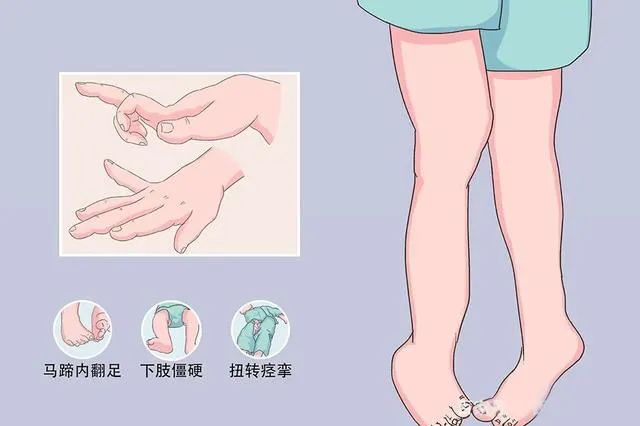 什么是肌张力？哪些原因导致肌张力过高？