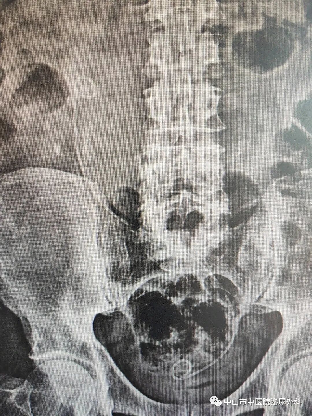 输尿管鞘是什么一期软镜治疗罕见交叉异位肾并结石（术中使用一次性末端可弯负压清石鞘）_https://www.jmylbn.com_新闻资讯_第5张