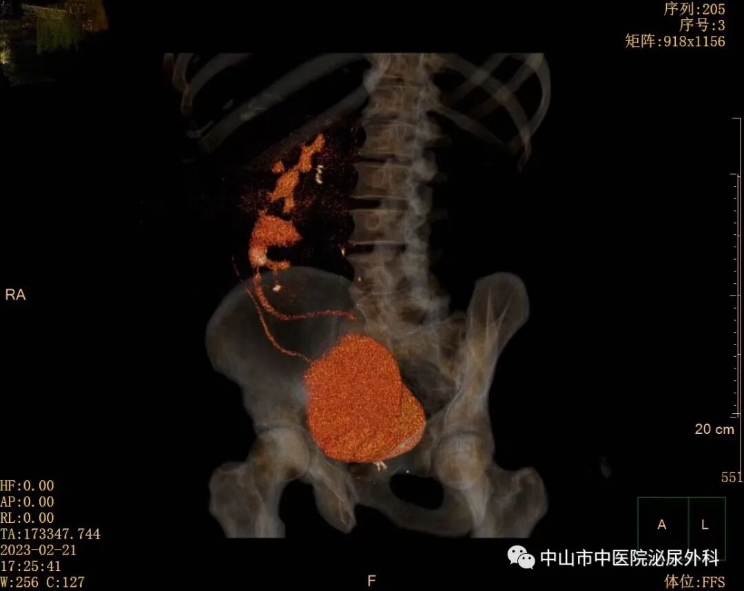 输尿管鞘是什么一期软镜治疗罕见交叉异位肾并结石（术中使用一次性末端可弯负压清石鞘）_https://www.jmylbn.com_新闻资讯_第4张