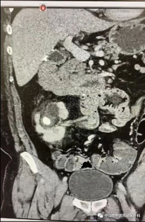 输尿管鞘是什么一期软镜治疗罕见交叉异位肾并结石（术中使用一次性末端可弯负压清石鞘）_https://www.jmylbn.com_新闻资讯_第3张