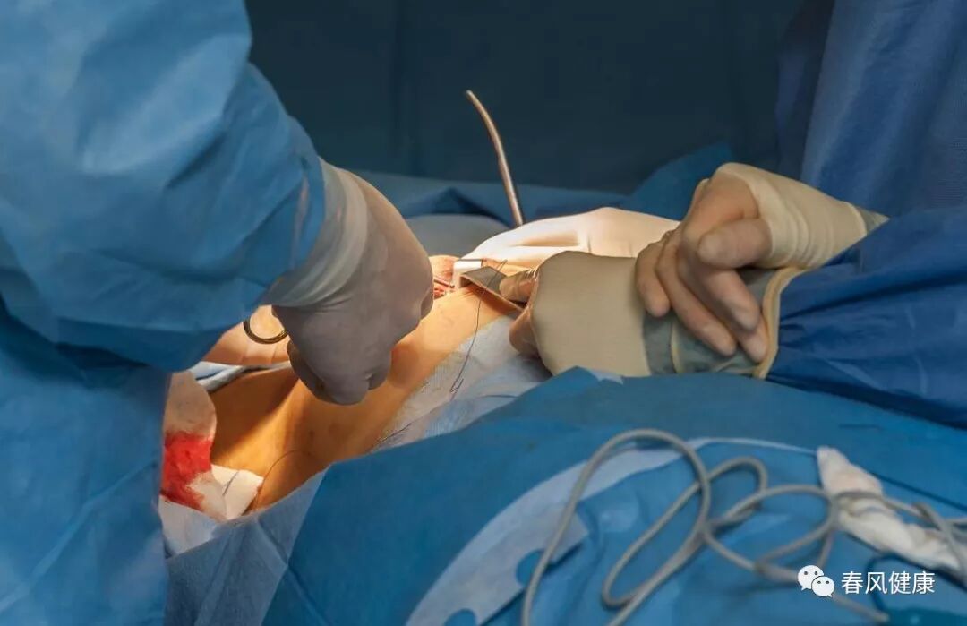 穿刺枪怎么升级乳腺穿刺术（三）_https://www.jmylbn.com_新闻资讯_第85张