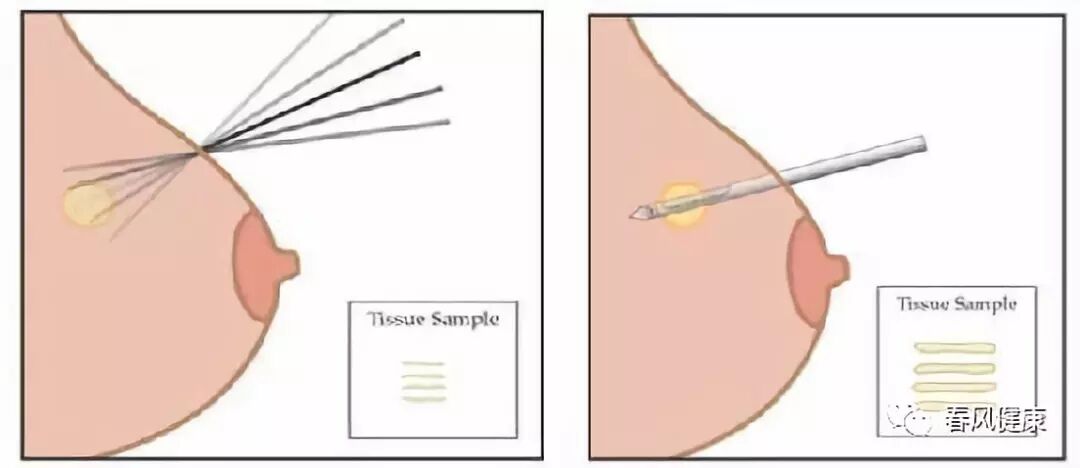 穿刺枪怎么升级乳腺穿刺术（三）_https://www.jmylbn.com_新闻资讯_第9张
