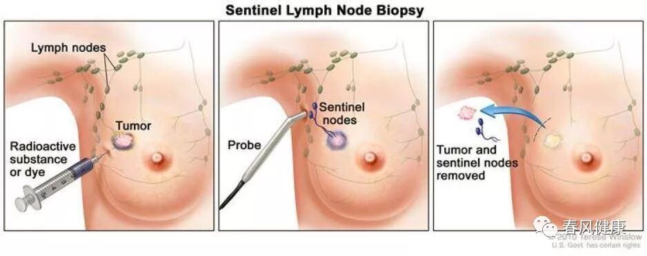 穿刺枪怎么升级乳腺穿刺术（三）_https://www.jmylbn.com_新闻资讯_第13张