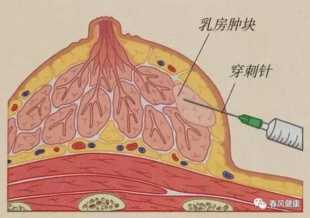 穿刺枪怎么升级乳腺穿刺术（三）_https://www.jmylbn.com_新闻资讯_第11张