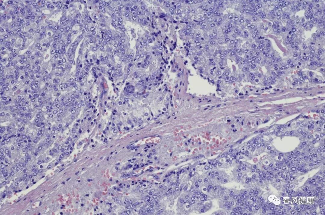 穿刺枪怎么升级乳腺穿刺术（三）_https://www.jmylbn.com_新闻资讯_第10张
