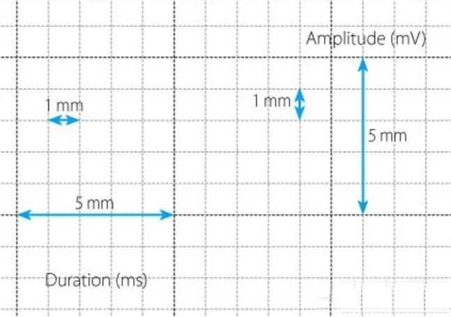 心电图滤波怎么选择【知跃干货】心电图基本示例_https://www.jmylbn.com_新闻资讯_第13张