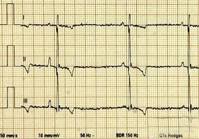 心电图滤波怎么选择【知跃干货】心电图基本示例_https://www.jmylbn.com_新闻资讯_第14张