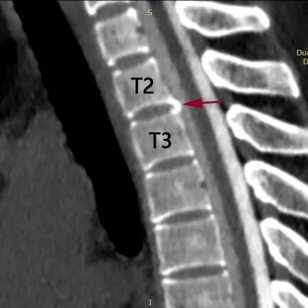 t3椎体图片图片