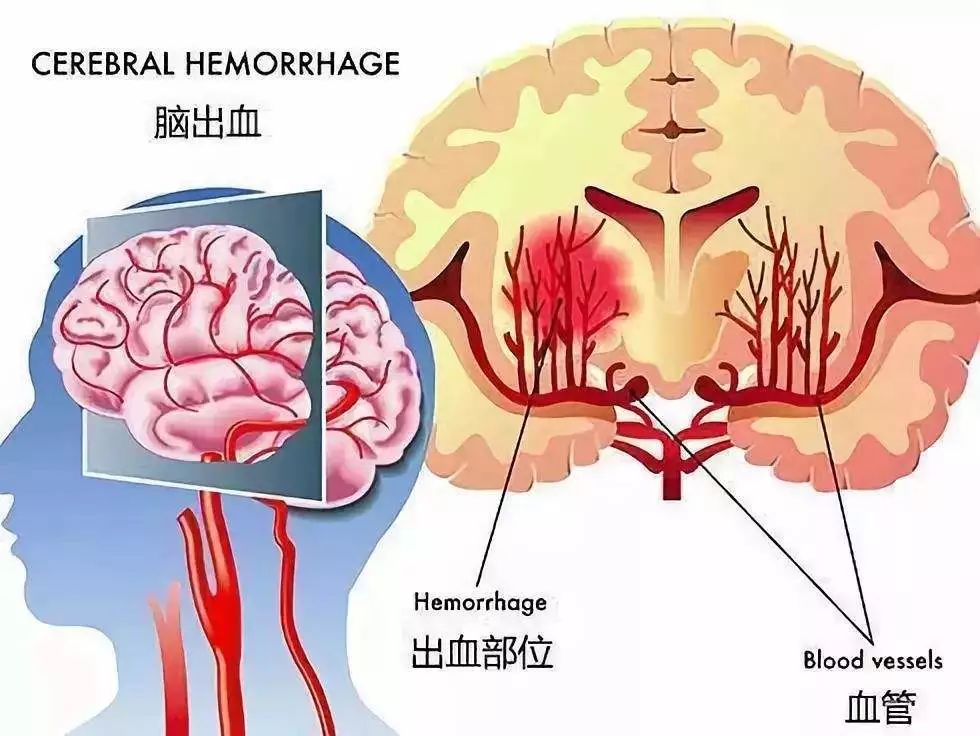 這病比癌症可怕！有人花了130萬沒救回來！有這些症狀要注意了！ 健康 第4張