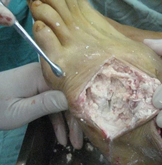 痛風，記住這些就夠了！ 健康 第4張