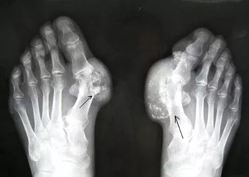 痛風，記住這些就夠了！ 健康 第5張