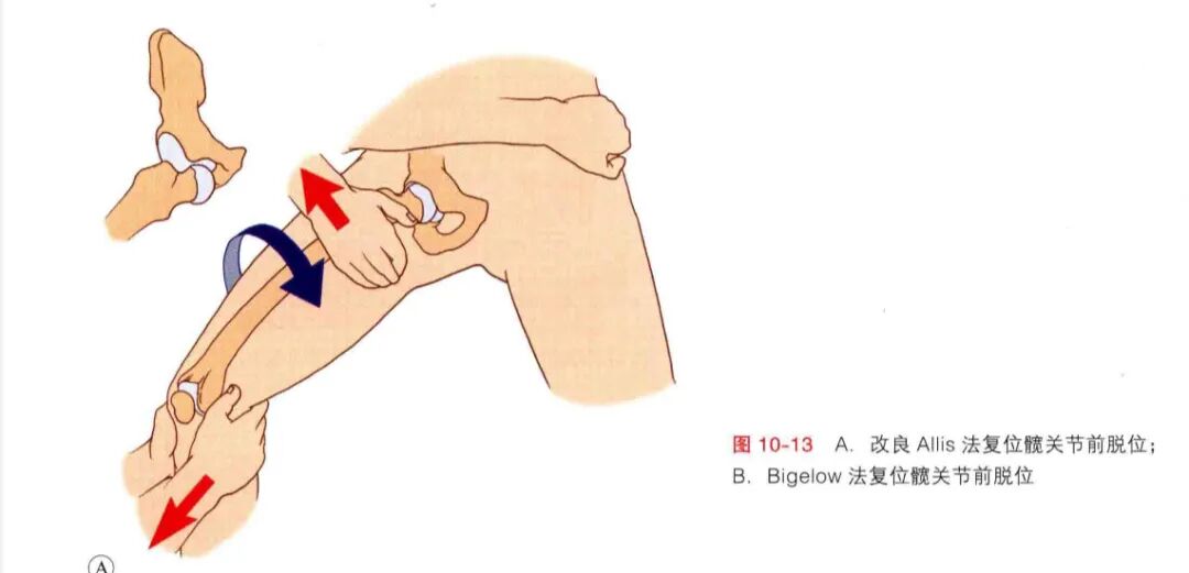 急诊来了髋关节脱位如何复位？骨科值班必备五种髋关节脱位闭合复位法！