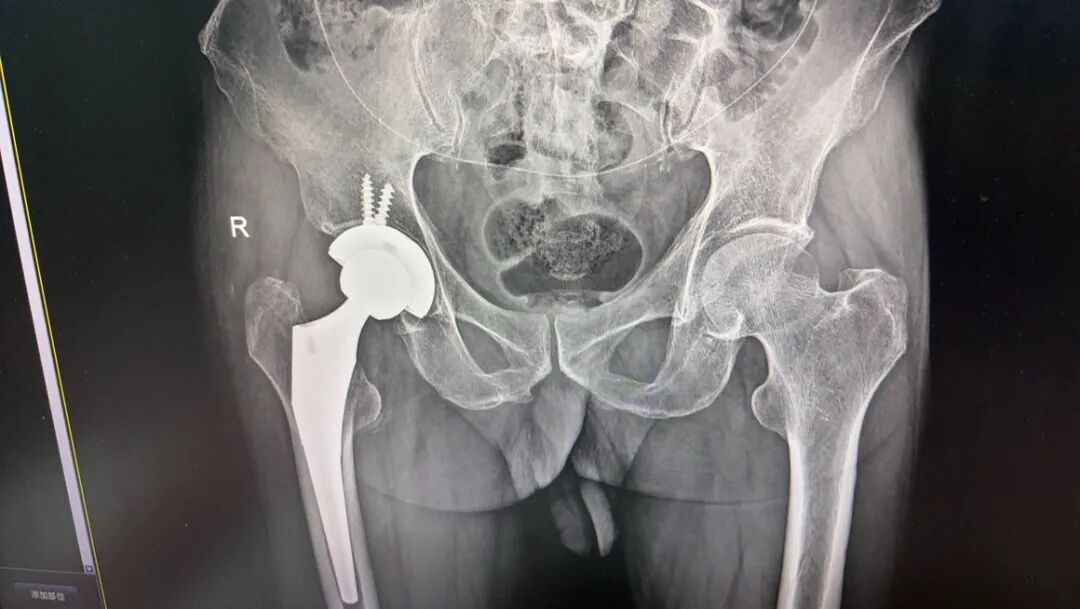 急诊来了髋关节脱位如何复位？骨科值班必备五种髋关节脱位闭合复位法！