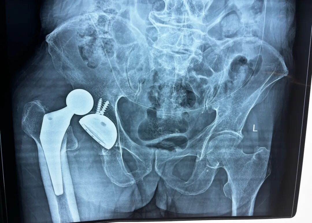 急诊来了髋关节脱位如何复位？骨科值班必备五种髋关节脱位闭合复位法！