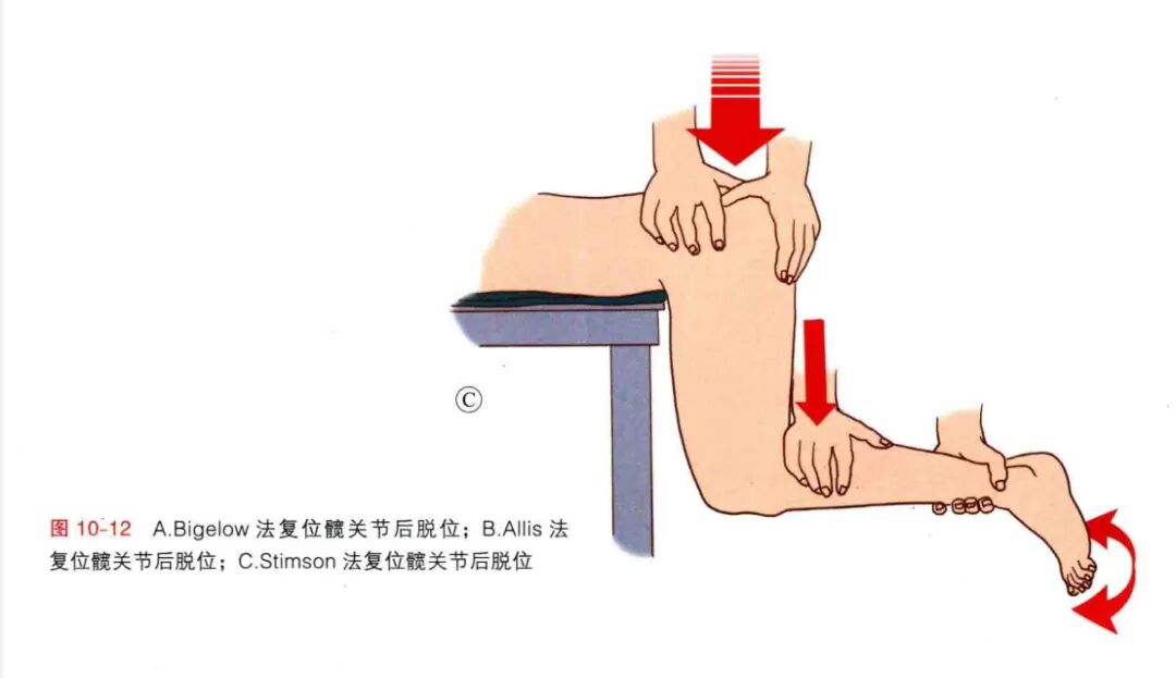 急诊来了髋关节脱位如何复位？骨科值班必备五种髋关节脱位闭合复位法！