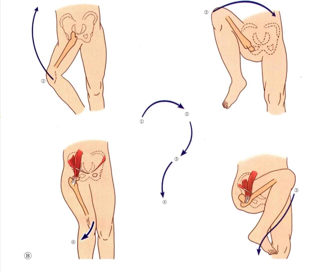 急诊来了髋关节脱位如何复位？骨科值班必备五种髋关节脱位闭合复位法！