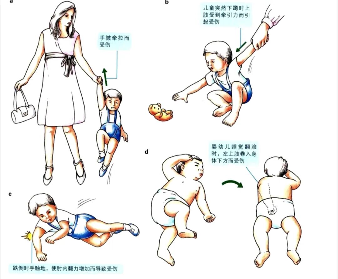 科普篇：一图了解如何在家里自己复位小儿桡骨小头半脱位“牵拉肘”！