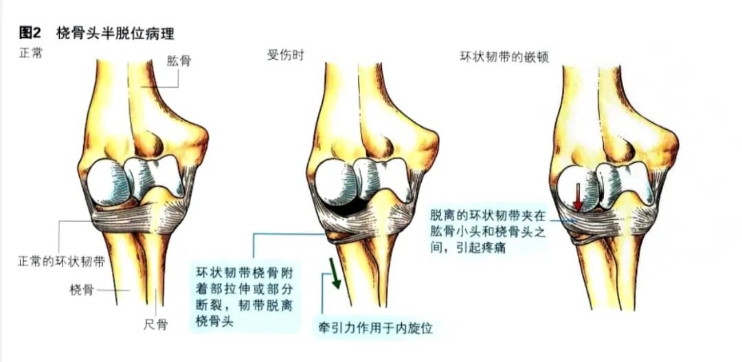 科普篇：一图了解如何在家里自己复位小儿桡骨小头半脱位“牵拉肘”！
