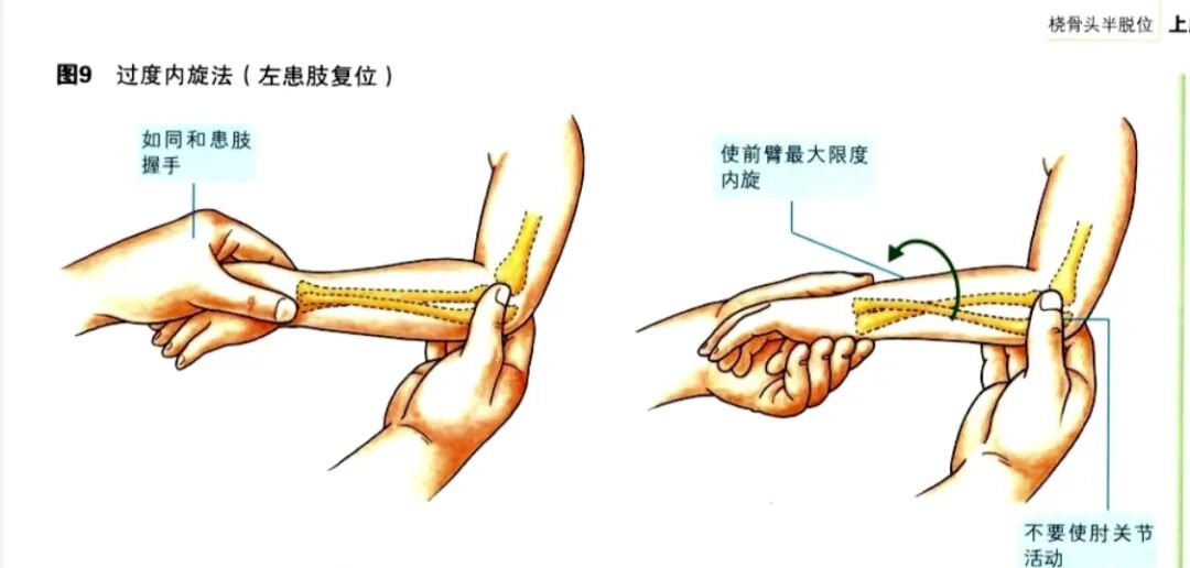 科普篇：一图了解如何在家里自己复位小儿桡骨小头半脱位“牵拉肘”！