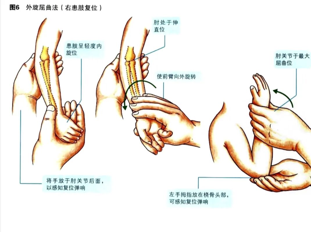 科普篇：一图了解如何在家里自己复位小儿桡骨小头半脱位“牵拉肘”！