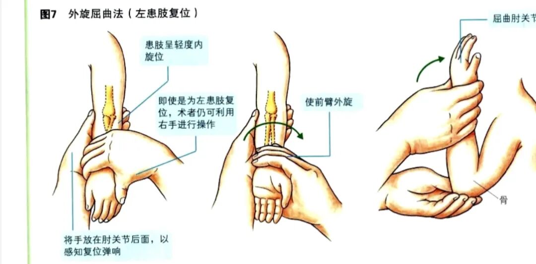 科普篇：一图了解如何在家里自己复位小儿桡骨小头半脱位“牵拉肘”！