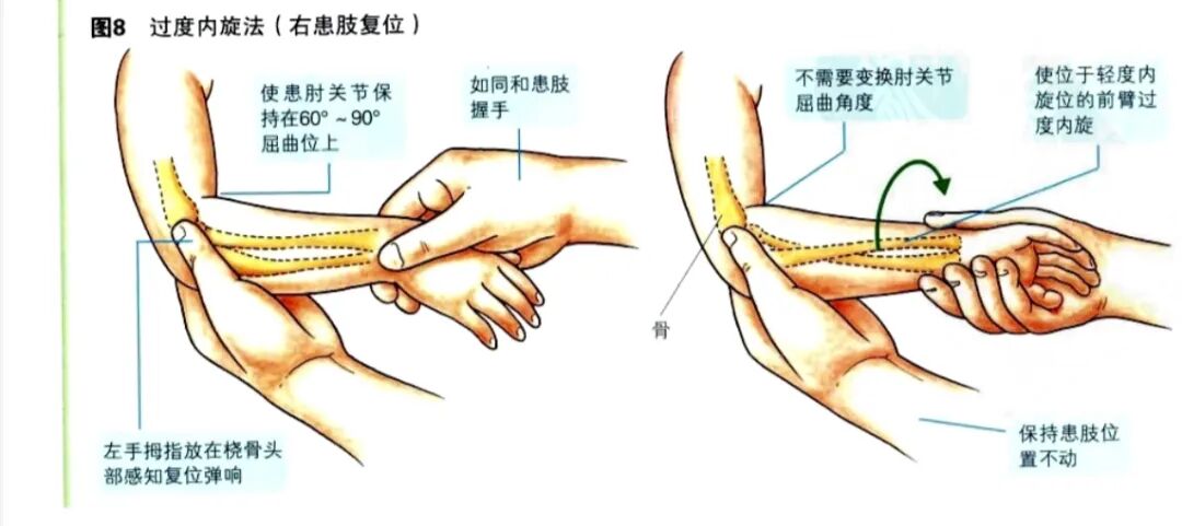 科普篇：一图了解如何在家里自己复位小儿桡骨小头半脱位“牵拉肘”！