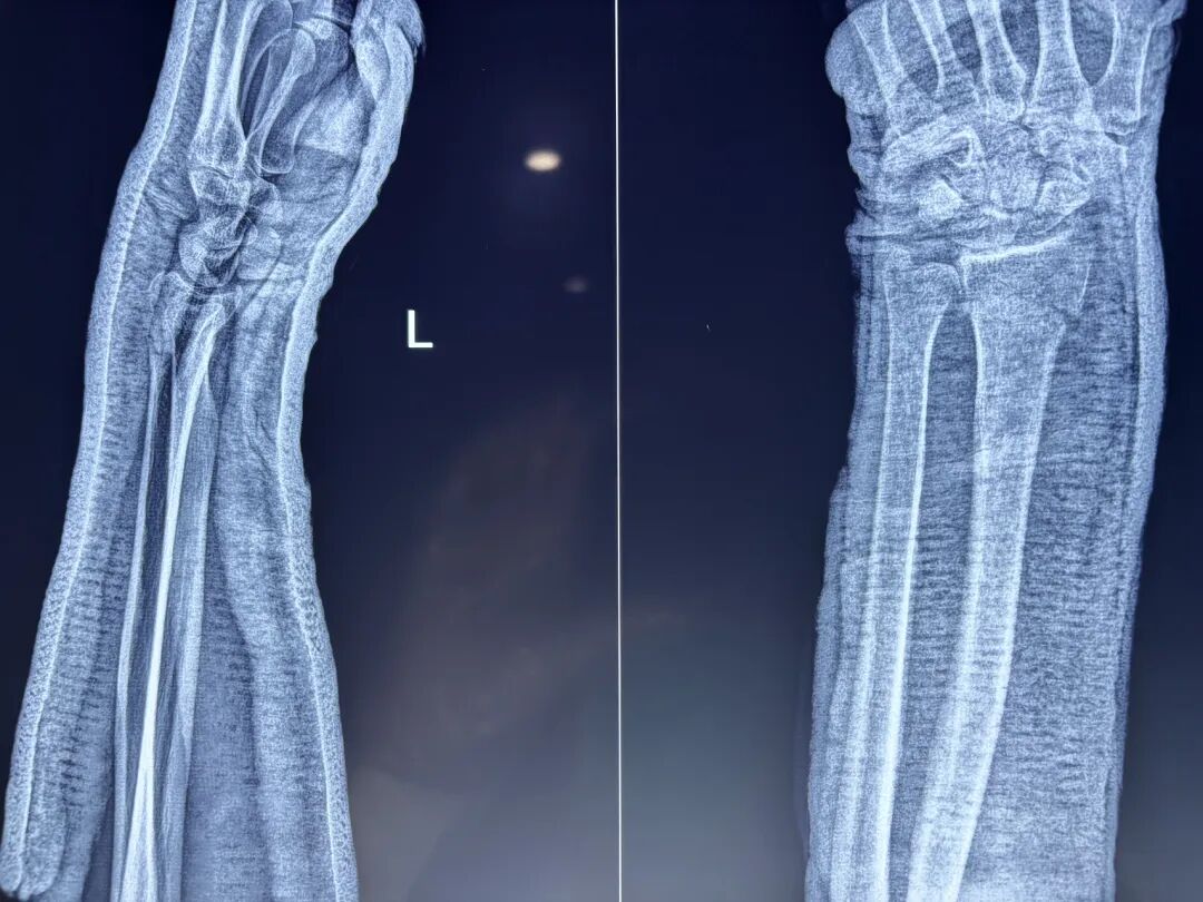 基层必备手法：桡骨远端骨折手法复位时如何避免掌侧遗留嵌插角度？