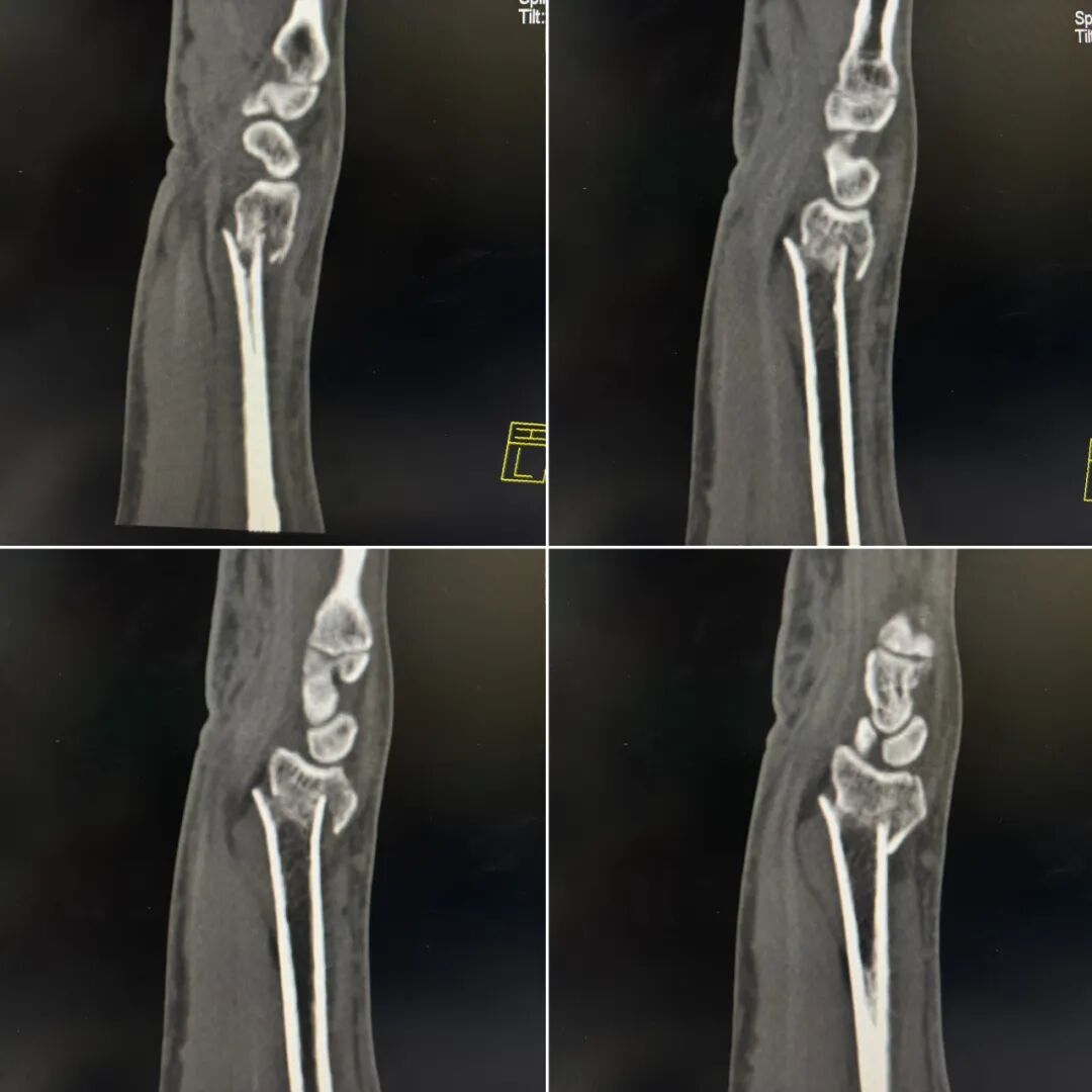 基层必备手法：桡骨远端骨折手法复位时如何避免掌侧遗留嵌插角度？