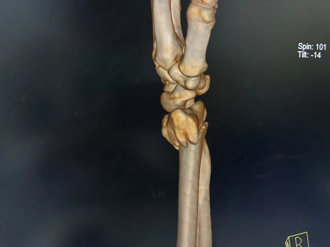 基层必备手法：桡骨远端骨折手法复位时如何避免掌侧遗留嵌插角度？