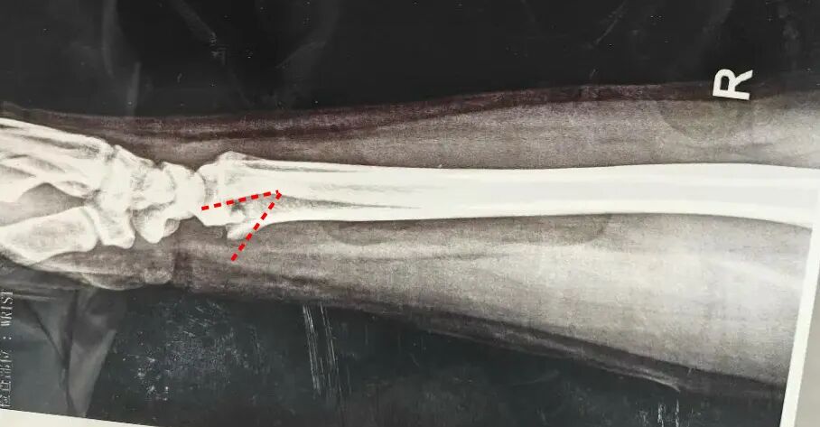 基层必备手法：桡骨远端骨折手法复位时如何避免掌侧遗留嵌插角度？