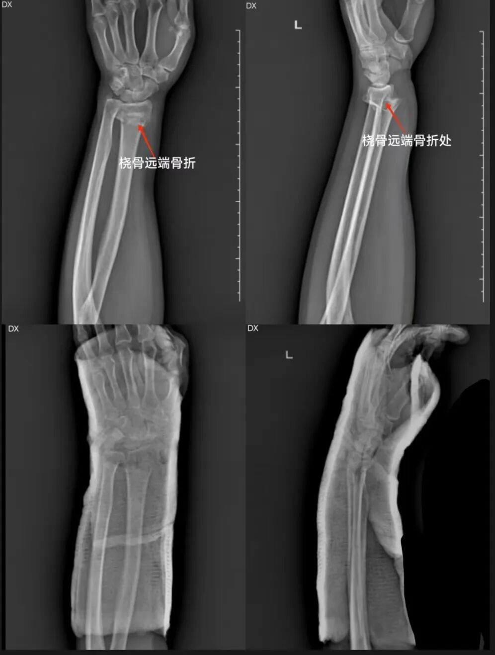 一文读懂：桡骨远端（克雷氏）骨折复位法