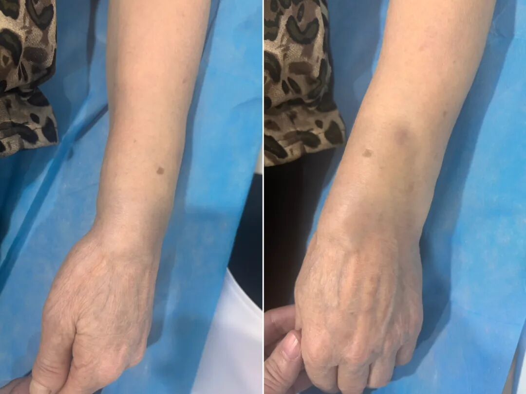 一文读懂：桡骨远端（克雷氏）骨折复位法