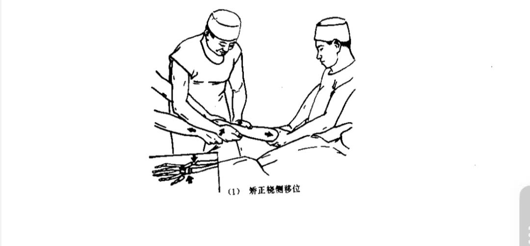 桡骨远端骨折详细手法复位法与复查、康复时间参考表！