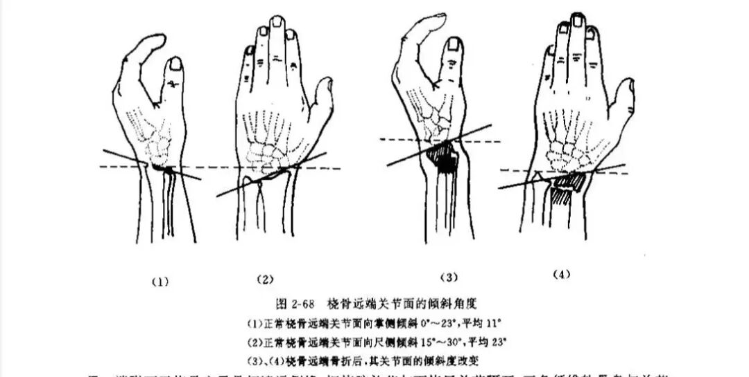桡骨远端骨折详细手法复位法与复查、康复时间参考表！