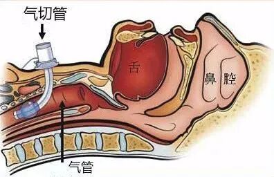 患者怎么选择人工鼻【硬核科普】气管切开的居家护理_https://www.jmylbn.com_新闻资讯_第6张