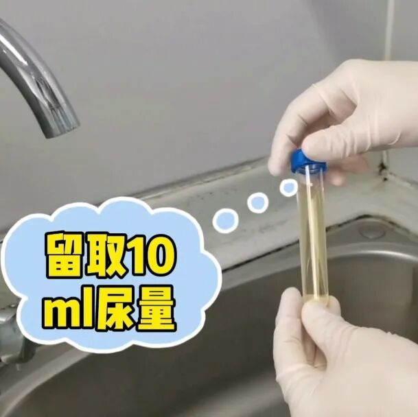 化验大便怎么采集【入院须知三】大小便标本留取全攻略：让你事半功倍的操作技巧！_https://www.jmylbn.com_新闻资讯_第7张