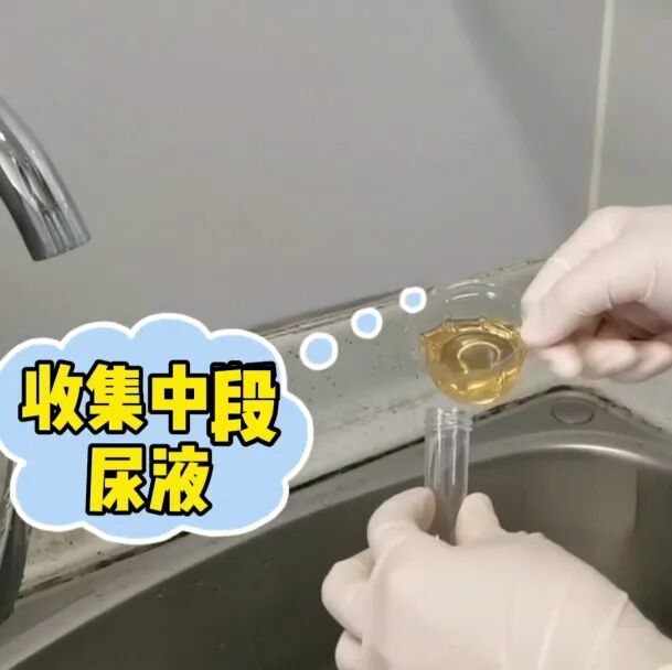 化验大便怎么采集【入院须知三】大小便标本留取全攻略：让你事半功倍的操作技巧！_https://www.jmylbn.com_新闻资讯_第8张