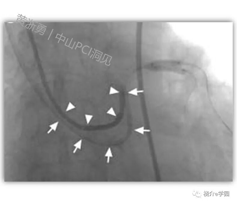 导管鞘怎么念中山PCI洞见｜64. 如何选择指引导管的内径？_https://www.jmylbn.com_新闻资讯_第6张