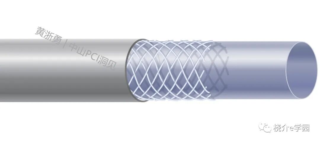 导管鞘怎么念中山PCI洞见｜64. 如何选择指引导管的内径？_https://www.jmylbn.com_新闻资讯_第4张