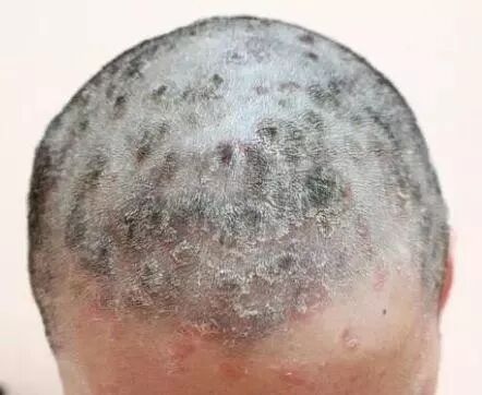 头发依附头皮而生,头皮一旦出现状况,头发也不可避免,油腻,干燥,变色