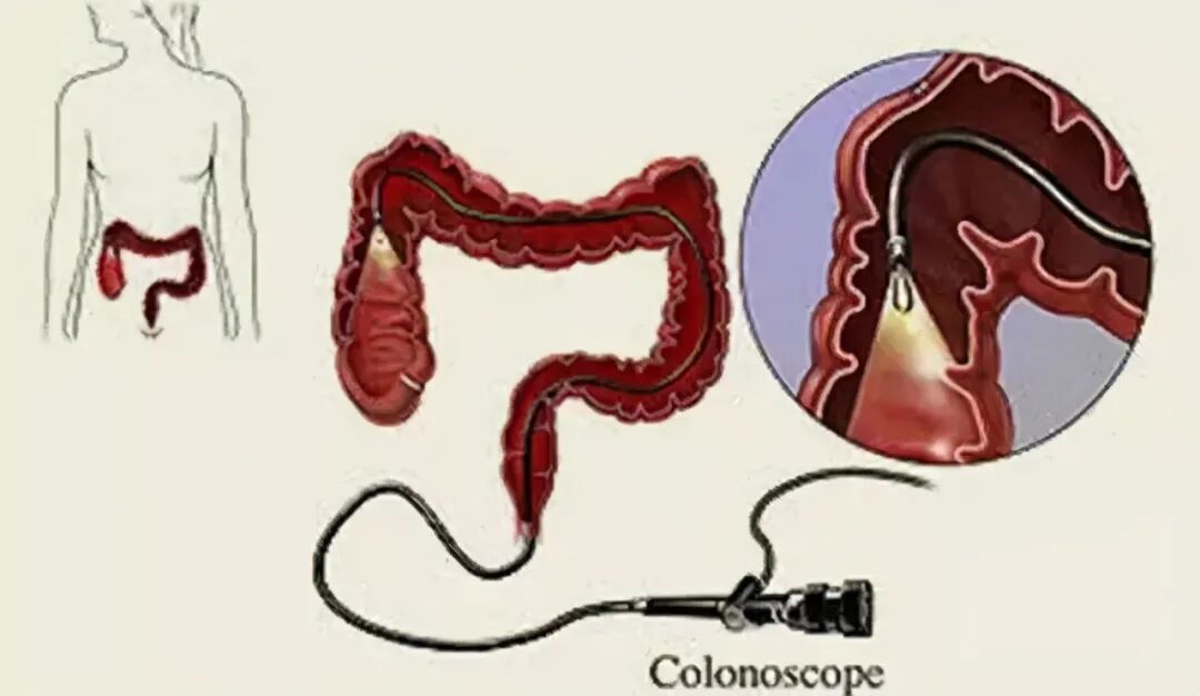 肠镜检查——全知道