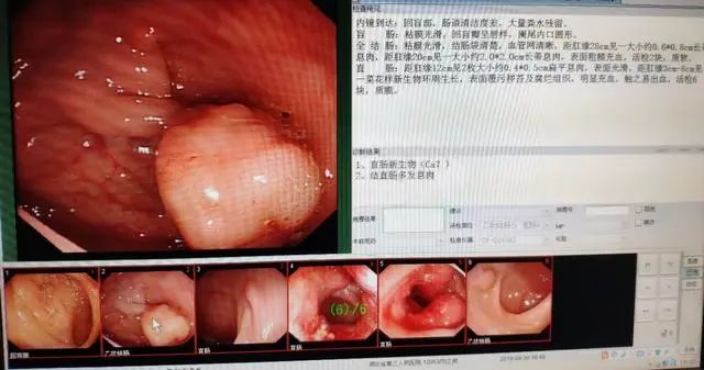 12個腸鏡就發現2例大腸癌6例腸息肉腸鏡檢查