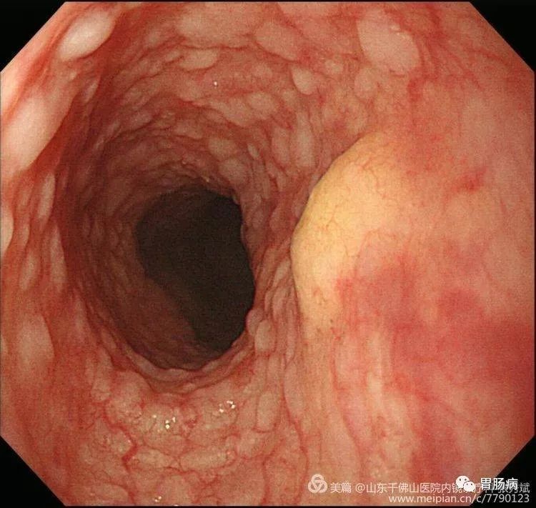 胃内多发丘疹样息肉,大小不等,1mm~30mm,表面光滑,息肉间黏膜凹凸不平