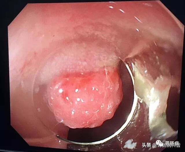 4岁孩子便血吓坏妈妈儿童无痛肠镜揪出真凶