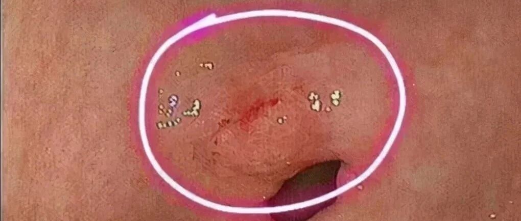 30岁，产后20天，确诊胃癌，没能坚持够100天 ——如何发现早期胃癌，医生有话说！