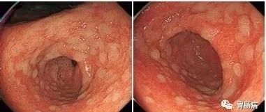 胃黏膜肠化生：一种癌前病变的防治